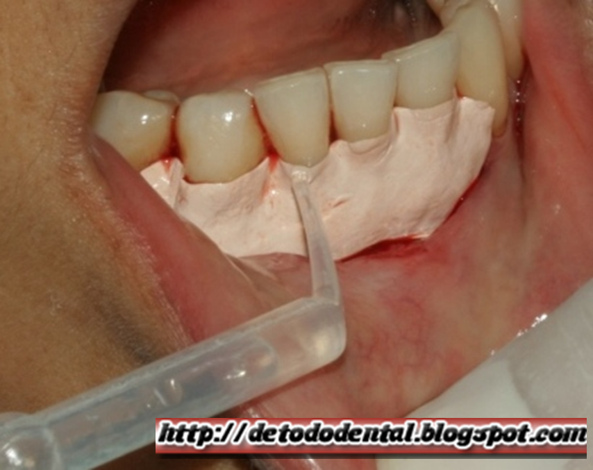 Dieta blanda despues de cirugia dental